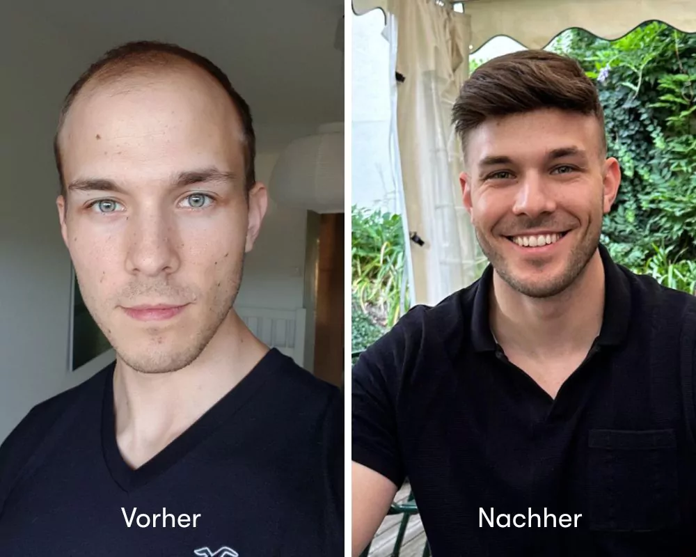 VorherNachher Florian Vorher Nachher mit Toupet zum Kleben bei O.C. Hairsystems